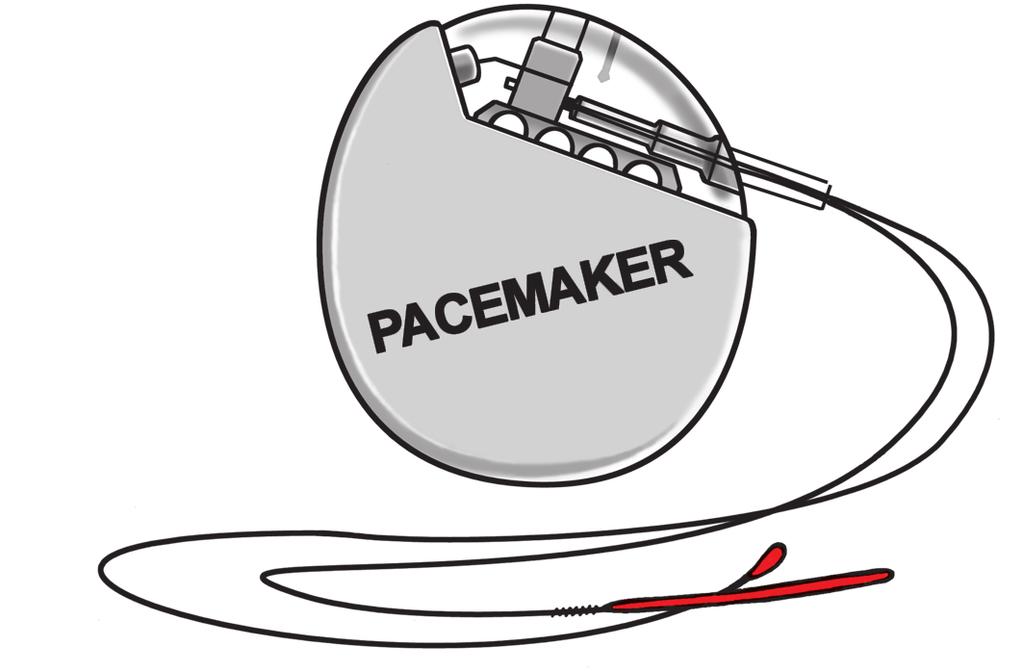 Pacemakers Een pacemaker (Engels voor gangmaker ) is een apparaatje dat het werk van de sinusknoop en/of de AV-knoop kan overnemen, zodat het hart in het normale tempo en ritme blijft pompen.