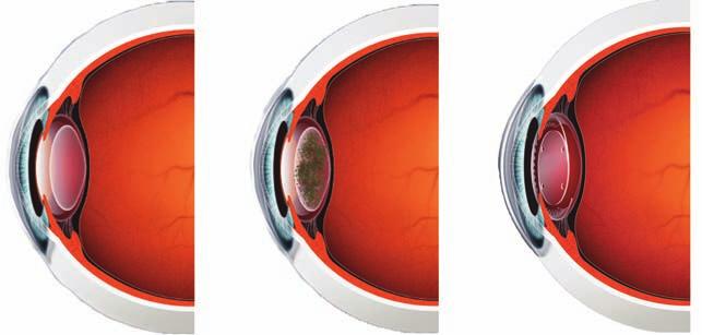 Het lensimplant De oplossing voor cataract en brilproblemen Lensimplanten worden reeds meer dan 50 jaar op grote schaal gebruikt in de oogheelkunde en behoren tot de meest succesvolle chirurgie die