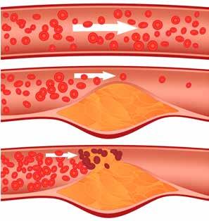 Nadelen Een verhoogd cholesterolgehalte in het bloed is niet zonder risico s. De overbodige cholesterol stapelt zich namelijk op en zet zich vast op de wanden van de slagaders.