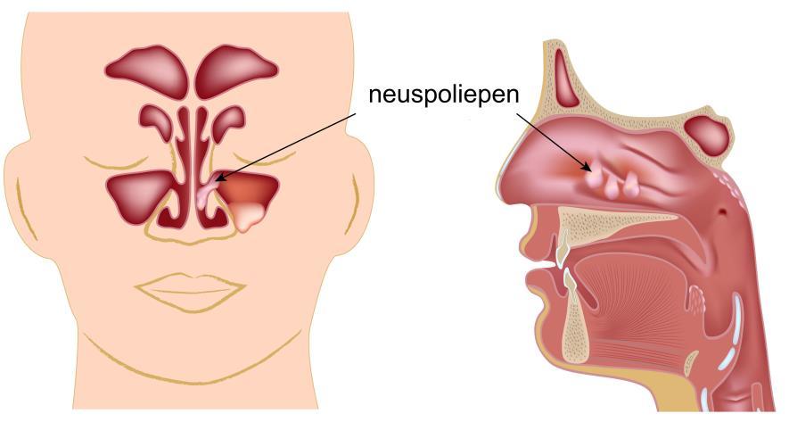 Afbeelding 2: neuspoliepen De oorzaak voor het ontstaan van neuspoliepen is nog onbekend. Er zijn factoren die de kans op neuspoliepen groter maken: Allergische aanleg.