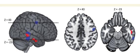 Veranderingen in het brein en object benoemen premotor temporalis medius Gecontroleerd voor: - lesievolume - leeftijd bij beroerte - tijd na beroerte bij T1 -