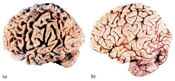 Neuropathologie Normaal gewicht: 1200-1500 gram Tot 500