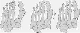 Figuur 3. Schematische weergave van een Basis-osteotomie Hallux rigidus Arthrodese Arthrodese betekent het vastzetten van het basisgewricht van de hallux.