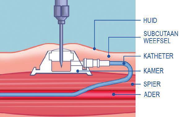 3 Door het gebruik van de poortkatheter blijven de oppervlakkig gelegen aders gespaard en worden de infusievloeistoffen en geneesmiddelen toegediend via een grote, dieper gelegen ader.