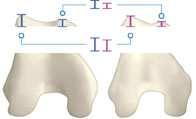 5) Wanneer er in dat geval een standaard prothese wordt geplaatst waarbij de dikte van de flange meer is dan het bot wat is weggezaagd ontstaat er overstuffing Dit wil zeggen dat de krachten van de