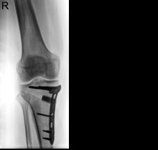 buitenzijde van de knie. Bij een X-been met slijtage zal de correctie aan de binnenkant van de knie worden uitgevoerd, meestal net boven de knie. Er wordt dan een wigje weggenomen.
