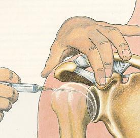 Injecteren in het gewricht Intra-articulair 1:4 2:3 bij