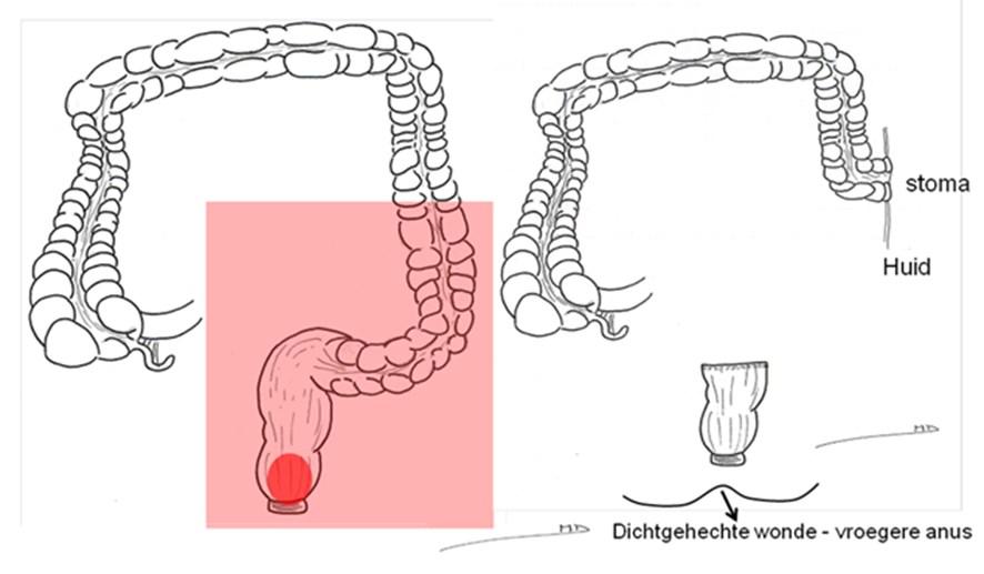 AbdominoPerineale RectumAmputatie of APRA-procedure Je ondergaat een wegname of resectie van het laatste deel van de dikdarm (de endeldarm of het rectum) met eveneens wegname van de sluitspier - dit