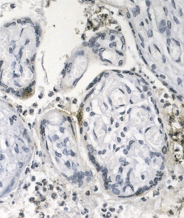 intervilleuze ruimte foetale bloedvaten placentavlokken infiltraat aankleurende trofoblastcellen Immunohistologisch onderzoek van de placenta van patiënt A met een monoklonale muizen-igg-antistof