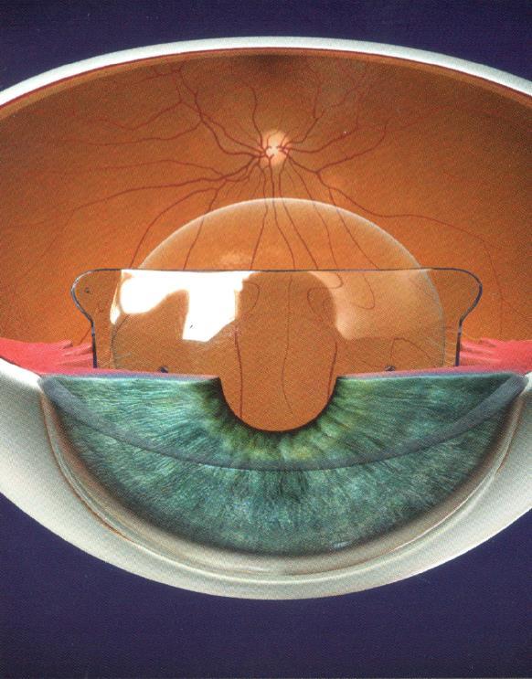 Voordelen tov LASIK Hogere refractieafwijkingen kunnen worden behandeld dan met LASIK. De behandeling is reversibel, indien nodig kan de ICL weer verwijderd worden.