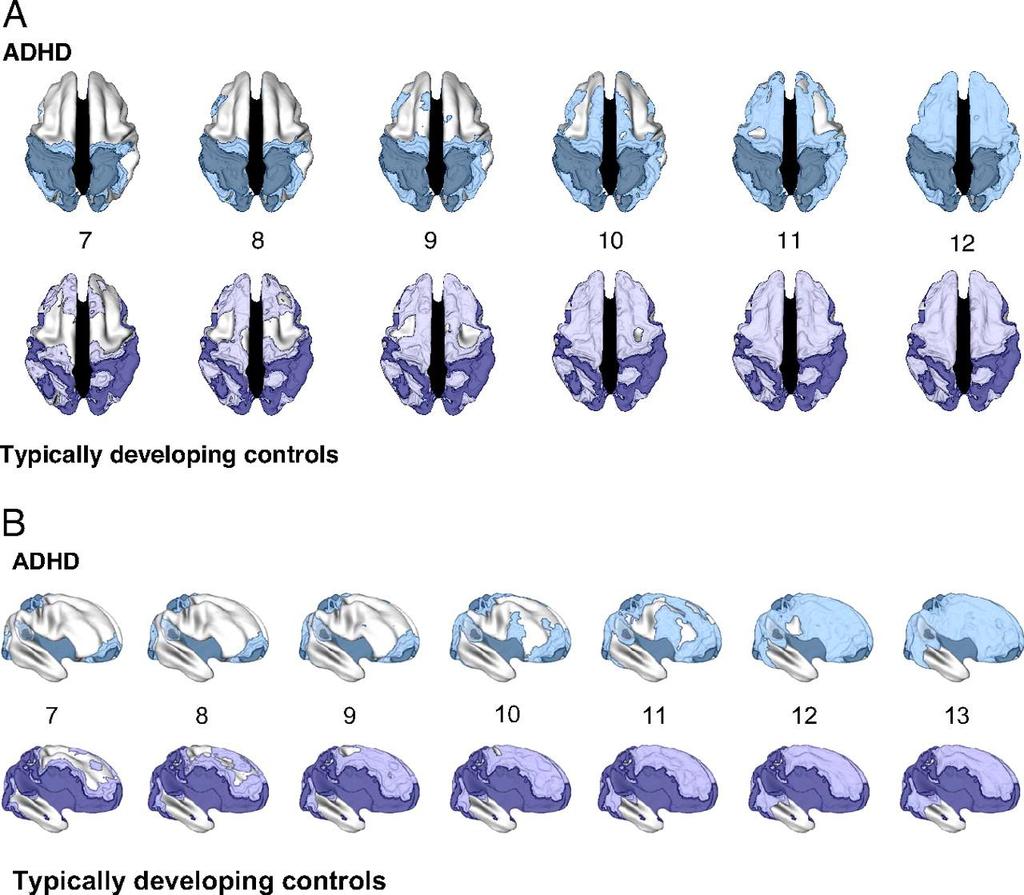 The age of attaining peak cortical thickness in children with ADHD compared with typically
