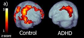 fmri Kijkt naar hersenactiviteit (bijv beelden beelden van doorbloeding van het brein) Bij meer activiteit een sterkere doorbloeding/hoger O2