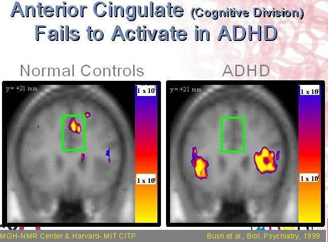 fmri scan In 1999 Dr Bush toonde aan afwijkingen op MRI scan een verschil in hersenactiviteit bij ADHD cliënten in vergelijking met cliënten zonder ADHD (li