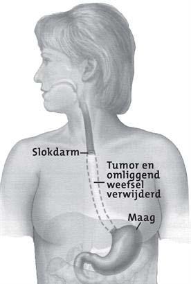 Onderzoek Aanleiding: Oesofagusresectie met