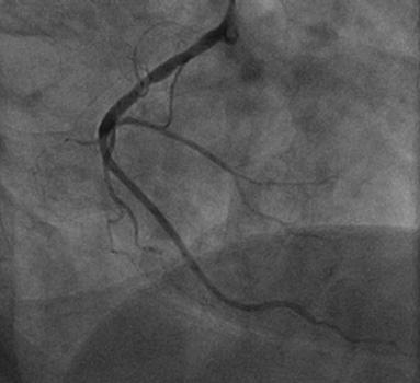 Wanneer een kransslagader vernauwd is, is de bloedtoevoer van de hartspier onvoldoende (vooral bij inspanning). Er treden dan hartpijnen op die we angina pectoris noemen.