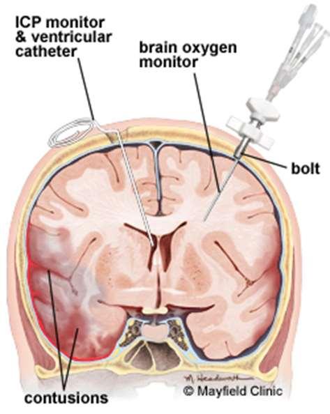 intracraniële druk de cerebrale oxygenatie Middelzwaar/Ernstig THL (3) Veelal afwijkingen bij beeldvormend onderzoek en neurologische uitval Epilepsie en heterotope ossificaties (vooral bij