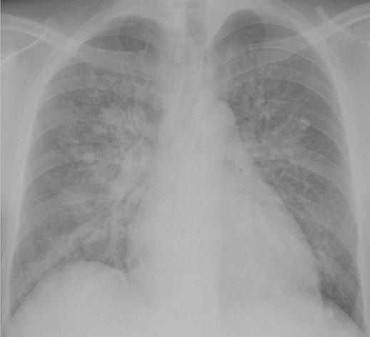 Inleiding (3) Classificeren pulmonaal