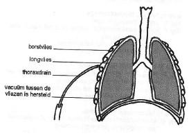Afbouwen van de drainage Als blijkt dat het vacuüm in de borstholte hersteld is, wordt de thoraxdrainage afgebouwd.