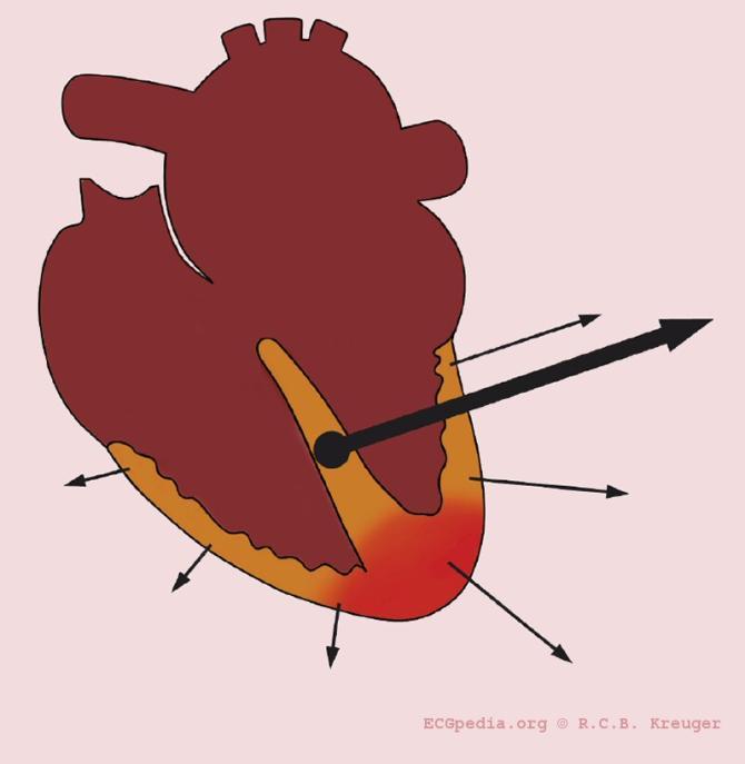 Linker hartas Linker anterior hemiblok