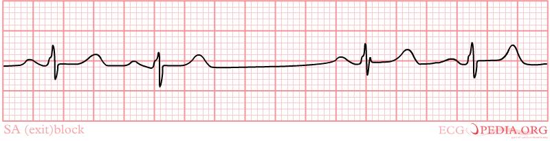 SA (exit)block plotseling uitval P-top en QRS