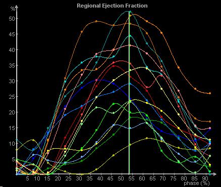 QRS=86 ms Synchrony/Asynchrony QRS=