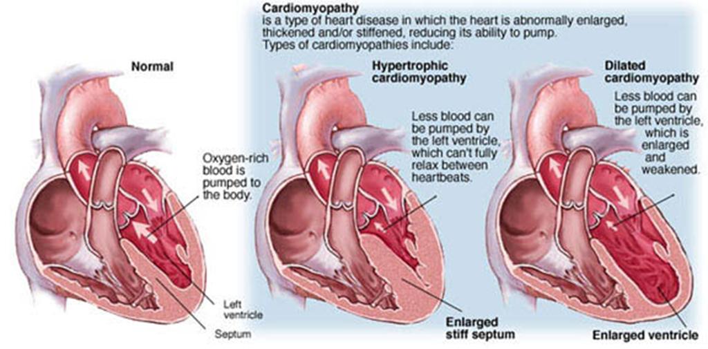 Cardiomyopathies prevalentie Hypertrophic cardiomyopathy (HCM) Dilated cardiomyopathy (DCM) Arrhythmogenic RV cardiomyopathy (ARVC)