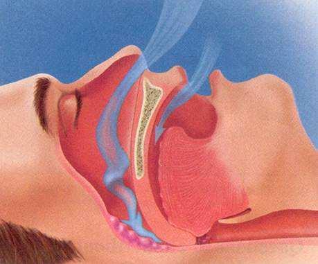 Apneus kunnen ook ontstaan doordat de hersenen te weinig prikkels afgeven om te ademen. Dit noemen we centrale slaapapneusyndroom, afgekort CSAS.