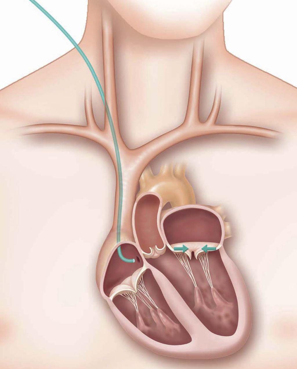 Stappen van de implantatie 1 Toegang De arts brengt een katheter in via een ader in de hals.