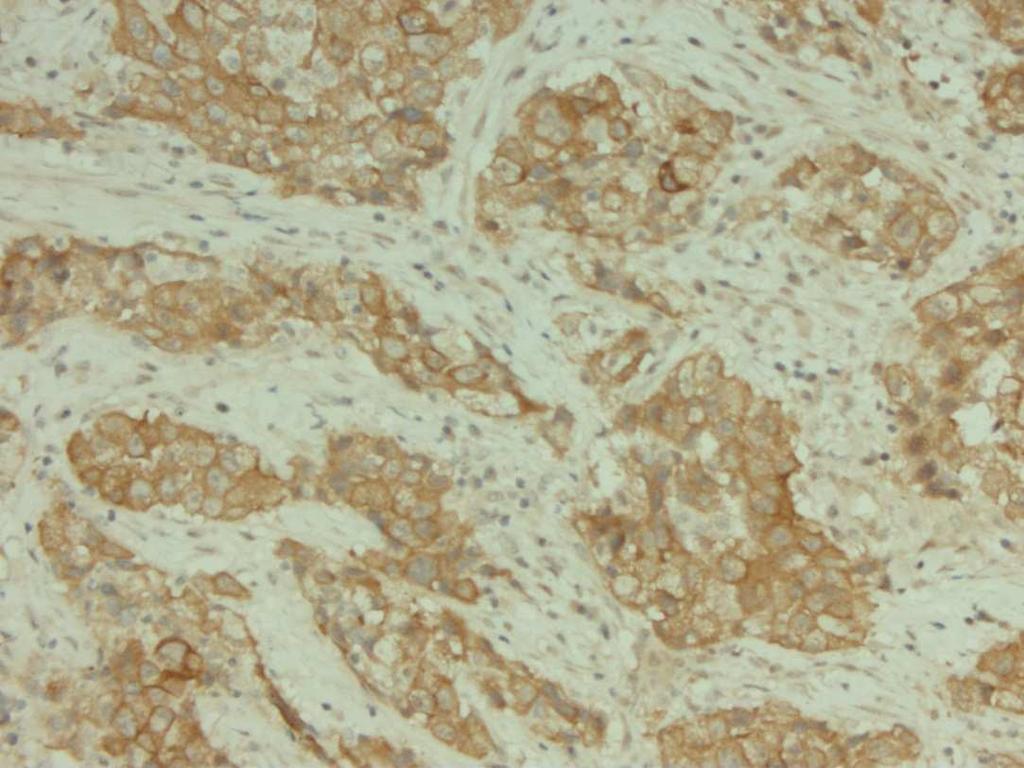 ALK1-IHC used for the detection of ALK-translocations in anaplastic lymphoma is not suitable for the detection of EML4-ALK inversion in NSCLC Is de expressie van ALK1 mbv IHC een alternatieve test