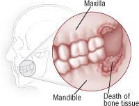 Risico gerelateerd aan cumulatieve blootstelling aan denosumab Slechte mondhygiëne en recente