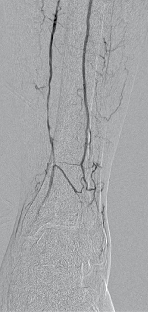 anterior KLINISCHE PR AKTIJK a stenose occlusie b stenose collaterale arterie c traject waar de anterior zou moeten lopen