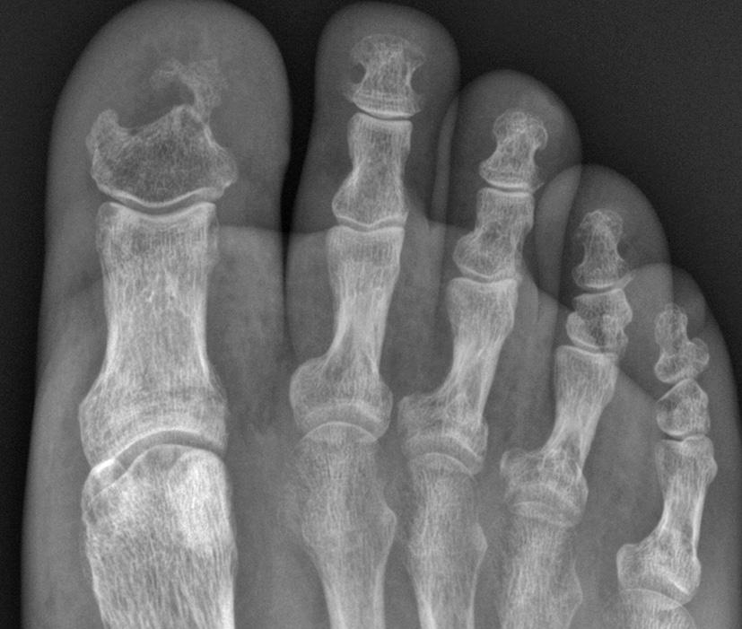 FIGUUR 4 Anterieur-posterieure röntgenfoto van de rechter voorvoet van patiënt B toont partiële destructie van de eindfalanx van de hallux met corticale erosies en sclerose.