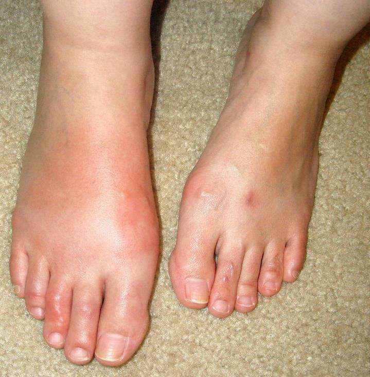 Acute Charcot Diabetes, ernstige neuropathie goede circulatie voet plots gezwollen, rood, warm
