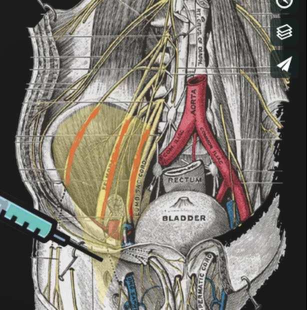 obturatorius Fascia iliaca compartment 3 zenuwen lopen samen met de (ilio)psoasspier vanuit 