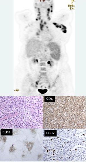 Angioimmunoblastic T-cell lymphoma(aitl) Vaak vergrote lever en milt, stadium III of IV Vaak huiduitslag, koorts Vaak oudere leeftijd Associatie met auto-immune ziekten Associatie