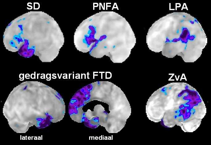 Ouderenpsychiatrie, 2010 Presymptomatic cognitive and neuroanatomical changes in