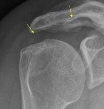 Tendinitis calcarea: röntgenfoto s