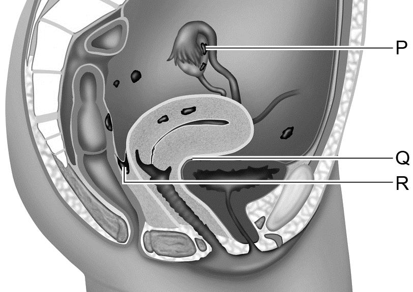 Endometriose Endometriose is een afwijking waarbij het baarmoederslijmvlies niet alleen in de baarmoeder zit, maar ook op andere plekken in de buikholte aanwezig is.