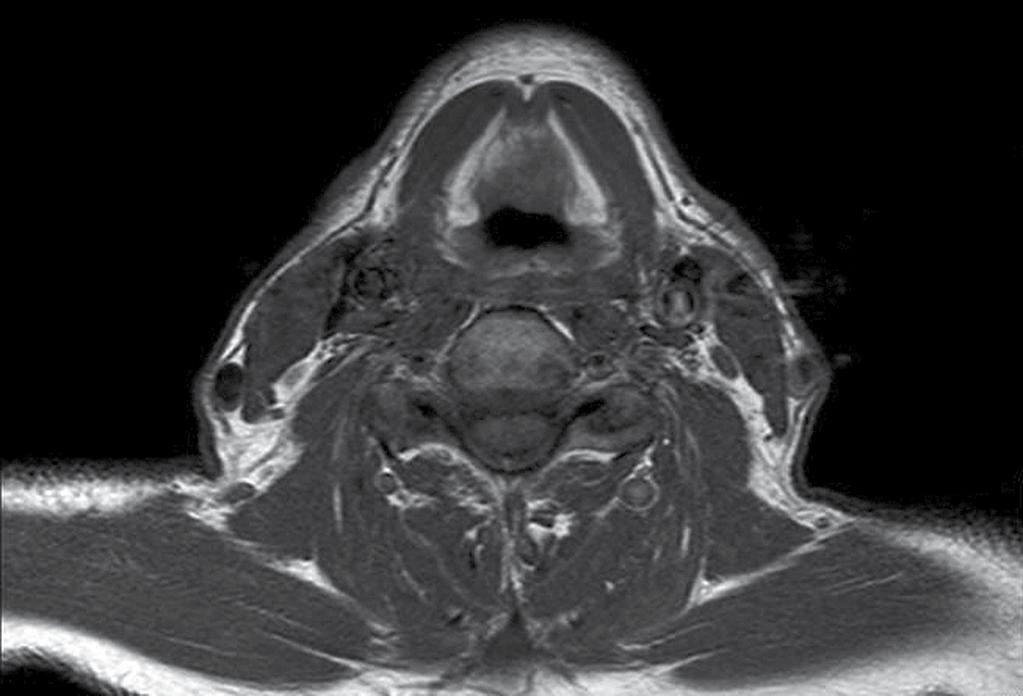 vestibulum laryngis cartilago thyroidea M.