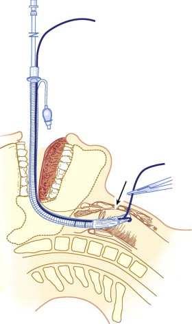retrograde intubation retrograde intubation alternatief voor fiber semi-blinde techniek verdienstelijk maar minder populair de invasieve luchtweg de