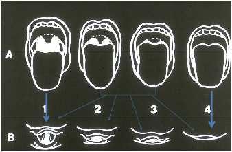 onderst snijtanden op zelfde lijn als bovenste upper-lip-bite