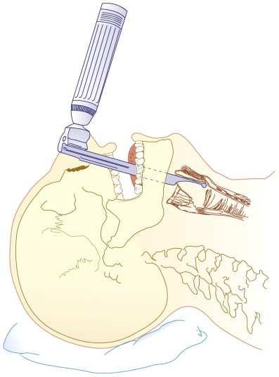optimalisatie directe laryngoscopie rechte laryngoscope (miller) maximum head extension / flexion tong maximaal naar links optimale