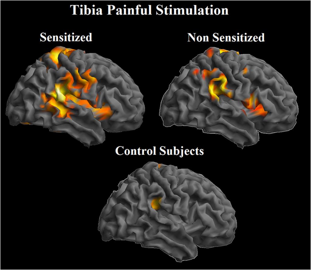 Descending Pain Inhibition systems Reduce pain;