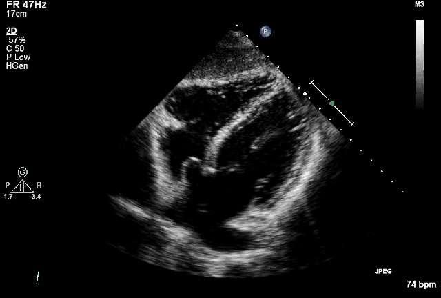 In beeld brengen v/h IAS: anterior- posterior