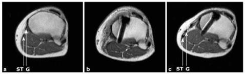 Knee Surg Sports Traumatol Arthrosc (2013) 21:898 905 DOI 10.