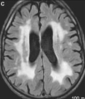 Erfelijke witte stofziekten Dementie Alzheimer FTD Witte stof