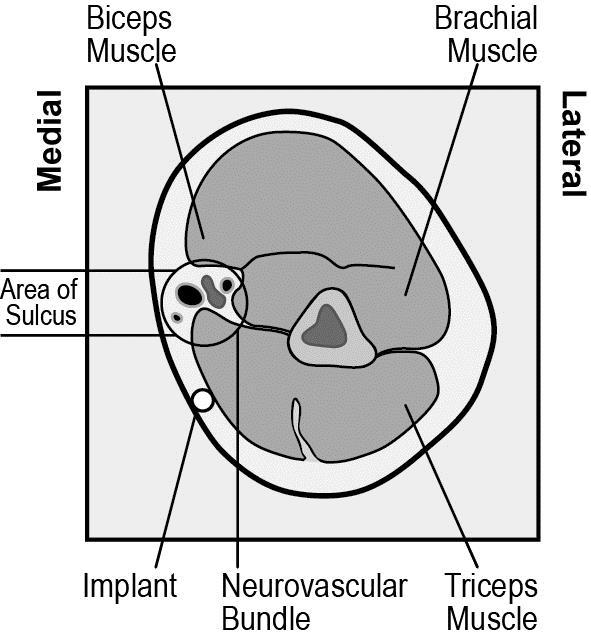 Belang van de subdermale plaatsing IMPLANON NXT (etonogestrelimplantaat) moet subdermaal worden ingebracht, NET ONDER DE HUID Als het implantaat te diep geplaatst wordt, kan dat neurale of vasculaire