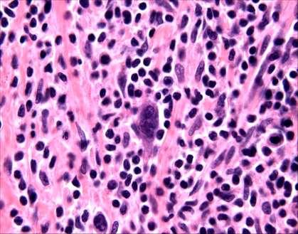Diagnose; Identificatie van Reed-Sternberg cellen in een mixed inflammatory achtergrond 20% 30% zijn EBV+ Behandeling: - Multi chemotherapie - Radiotherapie Zeer succesvol!