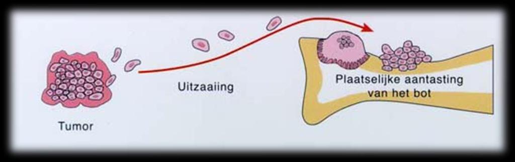 01 INLEIDING Uw oncoloog heeft u geïnformeerd dat u na uw behandeling in aanmerking komt voor een behandeling met Zometa.