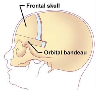 Ingreep Herstel van craniosynostose door middel van multiple osteotomies, dominant van het fronto-orbitale massief (fronto-orbitale advancement osteotomie ± interorbitale osteotomie).